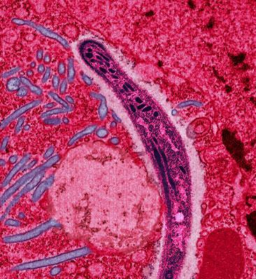 https://en.wikipedia.org/wiki/Malaria https://en.wikipedia.org/wiki/Malaria